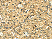 The image on the left is immunohistochemistry of paraffin-embedded Human liver cancer tissue using CSB-PA033492(LEP Antibody) at dilution 1/35, on the right is treated with fusion protein. (Original magnification: ×200)