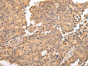 The image on the left is immunohistochemistry of paraffin-embedded Human prostate cancer tissue using CSB-PA033785(ALDH3A2 Antibody) at dilution 1/20, on the right is treated with fusion protein. (Original magnification: ×200)