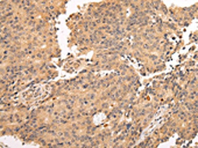 The image on the left is immunohistochemistry of paraffin-embedded Human prostate cancer tissue using CSB-PA033785(ALDH3A2 Antibody) at dilution 1/20, on the right is treated with fusion protein. (Original magnification: ×200)