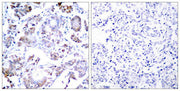 Immunohistochemical analysis of paraffin-embedded human breast carcinoma tissue using NFkB-p65(Ab-254) Antibody(left) or the same antibody preincubated with blocking peptide(right).