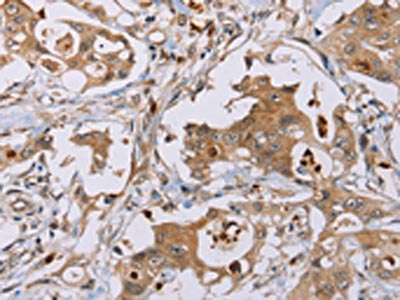 The image on the left is immunohistochemistry of paraffin-embedded Human colon cancer tissue using CSB-PA033931(OTC Antibody) at dilution 1/40, on the right is treated with fusion protein. (Original magnification: ×200)