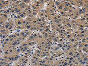 The image on the left is immunohistochemistry of paraffin-embedded Human liver cancer tissue using CSB-PA033958(ITGA11 Antibody) at dilution 1/40, on the right is treated with synthetic peptide. (Original magnification: ×200)