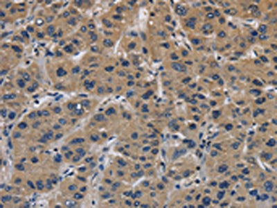 The image on the left is immunohistochemistry of paraffin-embedded Human liver cancer tissue using CSB-PA033958(ITGA11 Antibody) at dilution 1/40, on the right is treated with synthetic peptide. (Original magnification: ×200)