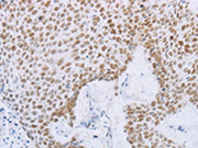 The image on the left is immunohistochemistry of paraffin-embedded Human lung cancer tissue using CSB-PA033980(MCM2 Antibody) at dilution 1/50, on the right is treated with fusion protein. (Original magnification: ×200)