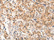 The image on the left is immunohistochemistry of paraffin-embedded Human gastic cancer tissue using CSB-PA034129(NOX4 Antibody) at dilution 1/20, on the right is treated with fusion protein. (Original magnification: ×200)