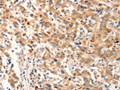 The image on the left is immunohistochemistry of paraffin-embedded Human gastic cancer tissue using CSB-PA034129(NOX4 Antibody) at dilution 1/20, on the right is treated with fusion protein. (Original magnification: ×200)