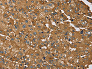 The image on the left is immunohistochemistry of paraffin-embedded Human liver cancer tissue using CSB-PA034142(RNF5 Antibody) at dilution 1/35, on the right is treated with synthetic peptide. (Original magnification: ×200)
