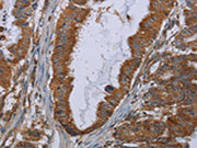 The image on the left is immunohistochemistry of paraffin-embedded Human esophagus cancer tissue using CSB-PA034458(INSIG2 Antibody) at dilution 1/30, on the right is treated with fusion protein. (Original magnification: ×200)