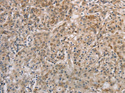 The image on the left is immunohistochemistry of paraffin-embedded Human gastic cancer tissue using CSB-PA034482(ESRRG Antibody) at dilution 1/30, on the right is treated with fusion protein. (Original magnification: ×200)