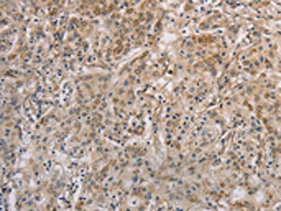 The image on the left is immunohistochemistry of paraffin-embedded Human gastic cancer tissue using CSB-PA034482(ESRRG Antibody) at dilution 1/30, on the right is treated with fusion protein. (Original magnification: ×200)