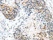 The image on the left is immunohistochemistry of paraffin-embedded Human esophagus cancer tissue using CSB-PA034529(TMPRSS4 Antibody) at dilution 1/45, on the right is treated with fusion protein. (Original magnification: ×200)