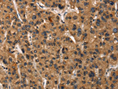 The image on the left is immunohistochemistry of paraffin-embedded Human liver cancer tissue using CSB-PA034616(DEFA5 Antibody) at dilution 1/15, on the right is treated with synthetic peptide. (Original magnification: ×200)