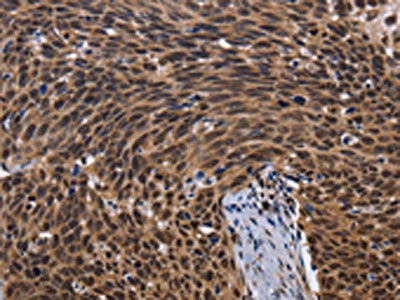 The image on the left is immunohistochemistry of paraffin-embedded Human cervical cancer tissue using CSB-PA034661(FASTKD5 Antibody) at dilution 1/40, on the right is treated with fusion protein. (Original magnification: ×200)