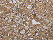The image on the left is immunohistochemistry of paraffin-embedded Human thyroid cancer tissue using CSB-PA034680(STMN2/STMN3/STMN4 Antibody) at dilution 1/45, on the right is treated with synthetic peptide. (Original magnification: ×200)