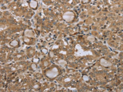 The image on the left is immunohistochemistry of paraffin-embedded Human thyroid cancer tissue using CSB-PA034680(STMN2/STMN3/STMN4 Antibody) at dilution 1/45, on the right is treated with synthetic peptide. (Original magnification: ×200)