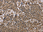 The image on the left is immunohistochemistry of paraffin-embedded Human liver cancer tissue using CSB-PA034681(NLRP4 Antibody) at dilution 1/40, on the right is treated with synthetic peptide. (Original magnification: ×200)