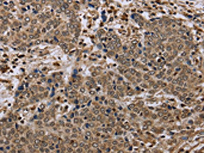 The image on the left is immunohistochemistry of paraffin-embedded Human liver cancer tissue using CSB-PA034681(NLRP4 Antibody) at dilution 1/40, on the right is treated with synthetic peptide. (Original magnification: ×200)