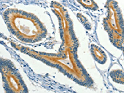 The image on the left is immunohistochemistry of paraffin-embedded Human colon cancer tissue using CSB-PA034861(KLC1 Antibody) at dilution 1/40, on the right is treated with fusion protein. (Original magnification: ×200)