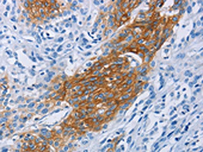 The image on the left is immunohistochemistry of paraffin-embedded Human esophagus cancer tissue using CSB-PA035070(CCR9 Antibody) at dilution 1/60, on the right is treated with fusion protein. (Original magnification: ×200)