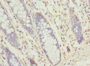 Immunohistochemistry of paraffin-embedded human colon cancer using CSB-PA03509A0Rb at dilution of 1:100