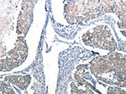 The image on the left is immunohistochemistry of paraffin-embedded Human breast cancer tissue using CSB-PA035138(Ccl6 Antibody) at dilution 1/50, on the right is treated with synthetic peptide. (Original magnification: ×200)