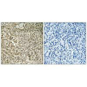 Immunohistochemistry analysis of paraffin-embedded human breast carcinoma tissue using RPL40 antibody.