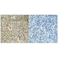 Immunohistochemistry analysis of paraffin-embedded human breast carcinoma tissue using RPL40 antibody.