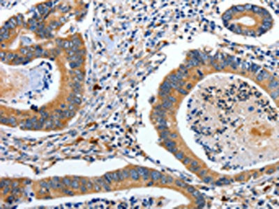 The image on the left is immunohistochemistry of paraffin-embedded Human colon cancer tissue using CSB-PA035369(EFNB2 Antibody) at dilution 1/80, on the right is treated with fusion protein. (Original magnification: ×200)