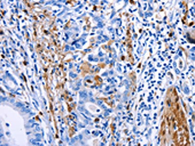 The image on the left is immunohistochemistry of paraffin-embedded Human stomach cancer tissue using CSB-PA035390(PTGS1 Antibody) at dilution 1/20, on the right is treated with synthetic peptide. (Original magnification: ×200)
