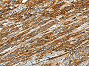 The image on the left is immunohistochemistry of paraffin-embedded Human esophagus cancer tissue using CSB-PA035530(CAV1 Antibody) at dilution 1/40, on the right is treated with synthetic peptide. (Original magnification: ×200)