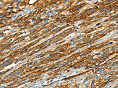 The image on the left is immunohistochemistry of paraffin-embedded Human esophagus cancer tissue using CSB-PA035530(CAV1 Antibody) at dilution 1/40, on the right is treated with synthetic peptide. (Original magnification: ×200)