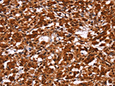 The image on the left is immunohistochemistry of paraffin-embedded Human thyroid cancer tissue using CSB-PA035565(HIPK1 Antibody) at dilution 1/30, on the right is treated with synthetic peptide. (Original magnification: ×200)