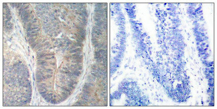 Immunohistochemical analysis of paraffin-embedded human colon carcinoma tissue using PKR(Phospho-Thr451) Antibody(left) or the same antibody preincubated with blocking peptide(right).