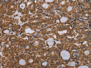 The image on the left is immunohistochemistry of paraffin-embedded Human thyroid cancer tissue using CSB-PA035787(PARP8 Antibody) at dilution 1/40, on the right is treated with synthetic peptide. (Original magnification: ×200)