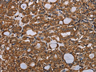 The image on the left is immunohistochemistry of paraffin-embedded Human thyroid cancer tissue using CSB-PA035787(PARP8 Antibody) at dilution 1/40, on the right is treated with synthetic peptide. (Original magnification: ×200)
