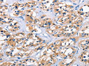 The image on the left is immunohistochemistry of paraffin-embedded Human thyroid cancer tissue using CSB-PA035949(APOL6 Antibody) at dilution 1/50, on the right is treated with synthetic peptide. (Original magnification: ×200)