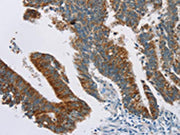 The image on the left is immunohistochemistry of paraffin-embedded Human colon cancer tissue using CSB-PA035961(RPS6KA2 Antibody) at dilution 1/20, on the right is treated with synthetic peptide. (Original magnification: ×200)