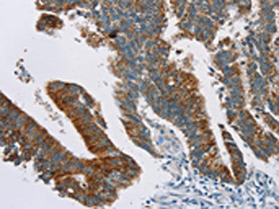 The image on the left is immunohistochemistry of paraffin-embedded Human colon cancer tissue using CSB-PA035961(RPS6KA2 Antibody) at dilution 1/20, on the right is treated with synthetic peptide. (Original magnification: ×200)