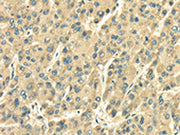 The image on the left is immunohistochemistry of paraffin-embedded Human liver cancer tissue using CSB-PA036156(SDF4 Antibody) at dilution 1/35, on the right is treated with fusion protein. (Original magnification: ×200)