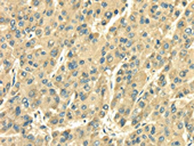 The image on the left is immunohistochemistry of paraffin-embedded Human liver cancer tissue using CSB-PA036156(SDF4 Antibody) at dilution 1/35, on the right is treated with fusion protein. (Original magnification: ×200)