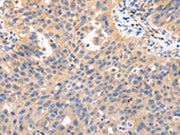 The image on the left is immunohistochemistry of paraffin-embedded Human ovarian cancer tissue using CSB-PA036177(IRS2 Antibody) at dilution 1/50, on the right is treated with synthetic peptide. (Original magnification: ×200)