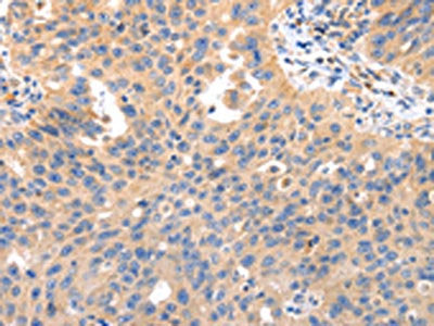 The image on the left is immunohistochemistry of paraffin-embedded Human ovarian cancer tissue using CSB-PA036177(IRS2 Antibody) at dilution 1/50, on the right is treated with synthetic peptide. (Original magnification: ×200)
