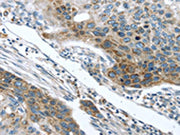 The image on the left is immunohistochemistry of paraffin-embedded Human esophagus cancer tissue using CSB-PA036396(TMPRSS5 Antibody) at dilution 1/25, on the right is treated with fusion protein. (Original magnification: ×200)