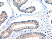 The image on the left is immunohistochemistry of paraffin-embedded Human colon cancer tissue using CSB-PA036665(FHL5 Antibody) at dilution 1/20, on the right is treated with fusion protein. (Original magnification: ×200)
