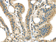 The image on the left is immunohistochemistry of paraffin-embedded Human thyroid cancer tissue using CSB-PA036719(STK35 Antibody) at dilution 1/45, on the right is treated with synthetic peptide. (Original magnification: ×200)