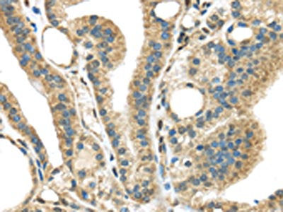 The image on the left is immunohistochemistry of paraffin-embedded Human thyroid cancer tissue using CSB-PA036719(STK35 Antibody) at dilution 1/45, on the right is treated with synthetic peptide. (Original magnification: ×200)