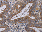 The image on the left is immunohistochemistry of paraffin-embedded Human colon cancer tissue using CSB-PA037047(ZC3H12A Antibody) at dilution 1/40, on the right is treated with fusion protein. (Original magnification: ×200)