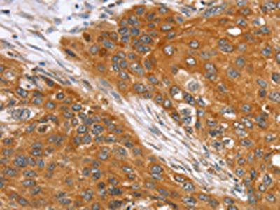 The image on the left is immunohistochemistry of paraffin-embedded Human esophagus cancer tissue using CSB-PA037067(SLC25A13 Antibody) at dilution 1/35, on the right is treated with fusion protein. (Original magnification: ×200)