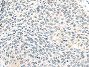 The image on the left is immunohistochemistry of paraffin-embedded Human lung cancer tissue using CSB-PA037081(TCEB1 Antibody) at dilution 1/40, on the right is treated with fusion protein. (Original magnification: ×200)