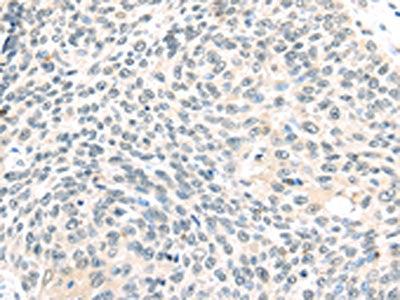 The image on the left is immunohistochemistry of paraffin-embedded Human lung cancer tissue using CSB-PA037081(TCEB1 Antibody) at dilution 1/40, on the right is treated with fusion protein. (Original magnification: ×200)